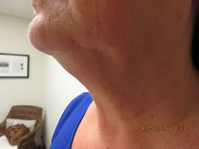 EMSCULPT NEO after photo