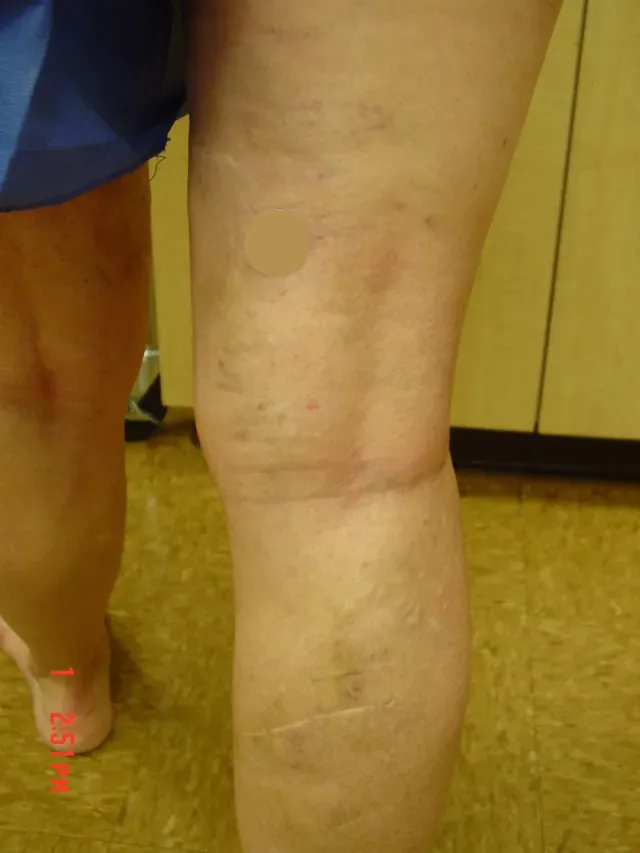 After spider vein treatment