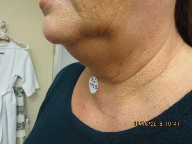 EMSCULPT NEO before photo